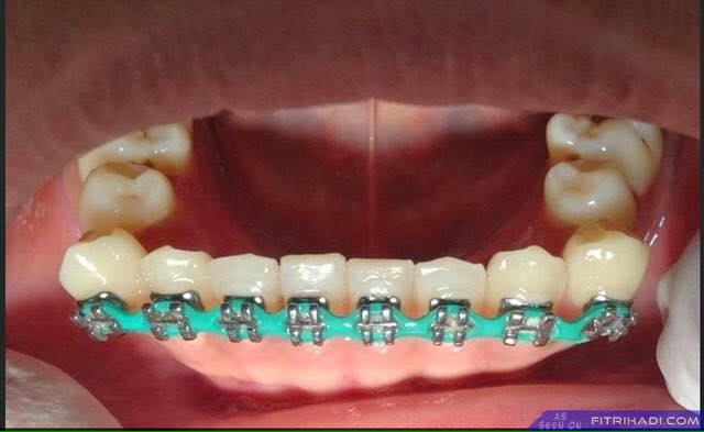 Braces3