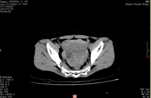 Cyst1