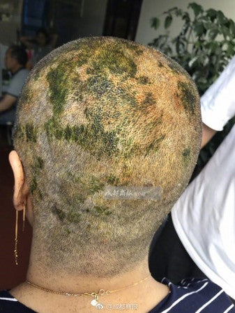 woman suffers burns on scalp and forced to go bald after dyeing hair in salon world of buzz 3