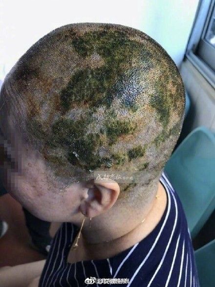 Woman Suffers Burns On Scalp World Of Buzz