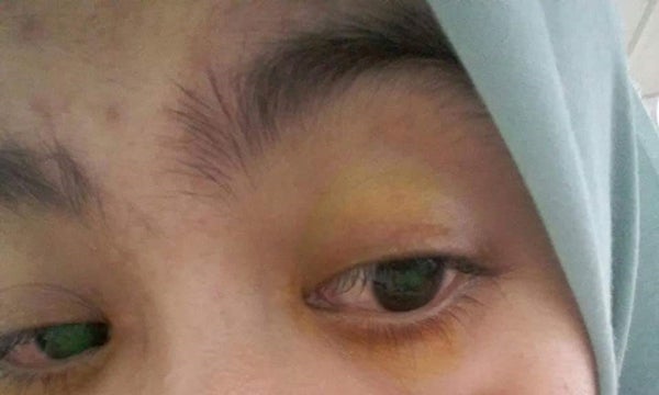 Mata Pedih Kabur Dan Berair Mata Gadis Rosak Selepas Pakai Contact Lens Ini Lobak Merah