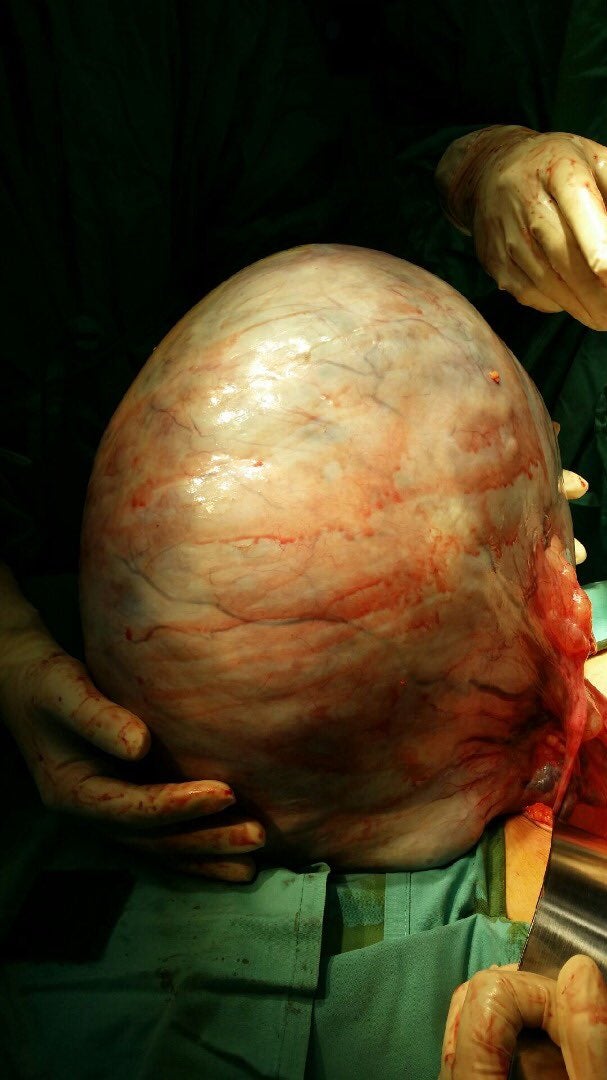 Cyst Ovari