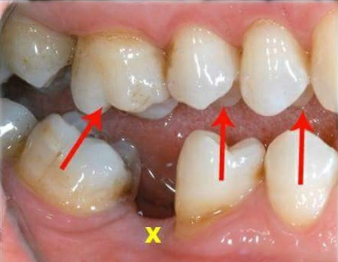 Tampal Sahaja Kalau Gigi Tu Berlubang Dentist Ini Kongsikan 6 Kesan Masa Panjang Kalau Korang Terus Cabut Lobak Merah