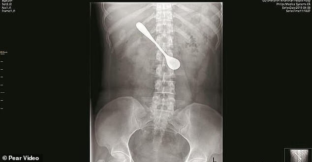 12335214 6927327 An x ray image shows the shadow of the metal spoon in the female a 14 1555410454480