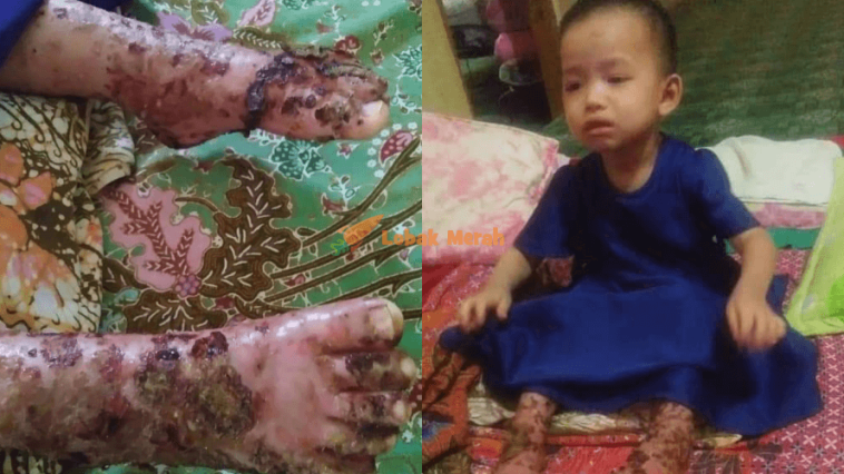 Derita sakit kulit Archives - Lobak Merah