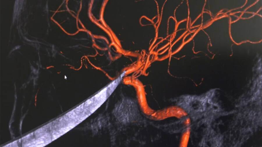 Computer Model Blade Carotid