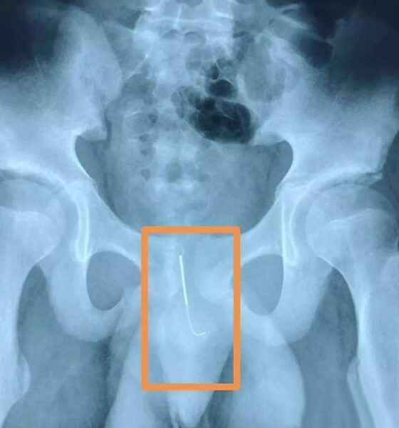 urethra 1 1