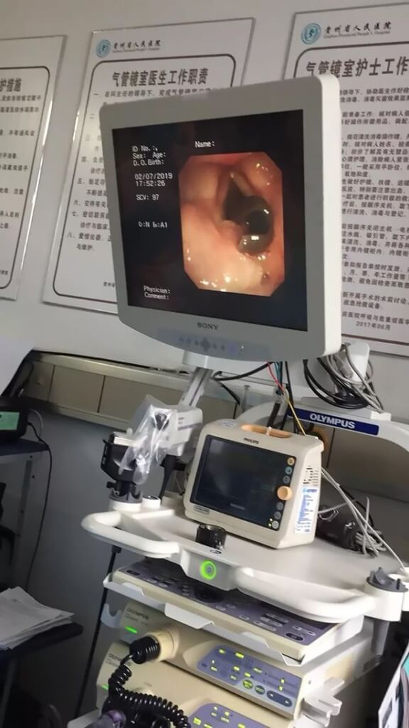 woman coughs out blood doctor finds 3cm leech in her throat world of buzz