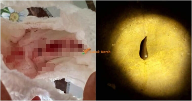 lintah masuk vagina