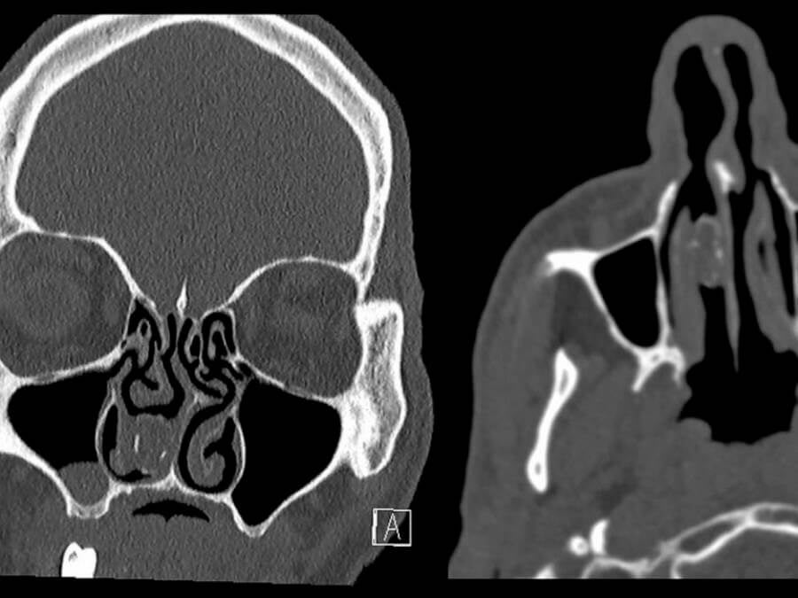 ct scan of pot inside nose