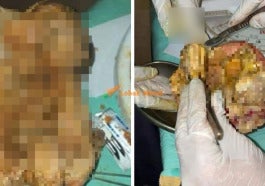 Woman Who Complained Of Abdominal Pains Discovers Dead Baby That Was Inside For 15 Years World Of Buzz