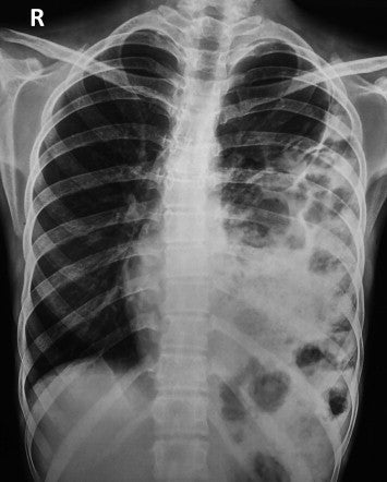 Diaphragm 1