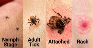 Ticks And Lyme Disease Fb