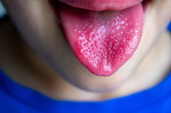 Tongue