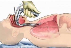 Intubation 2