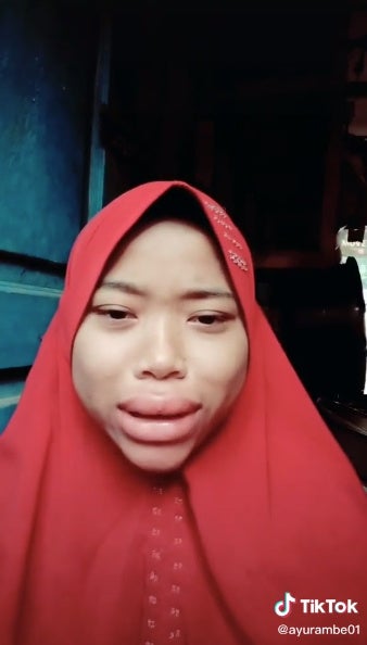 Tik Tok Bibir 3 Bengkak