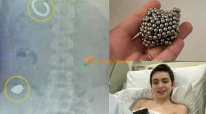 Nak tahu melekat dalam perut atau tak Sebab Curious Remaja Ini Telan 54 Biji Bebola Magnet