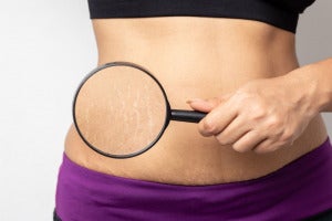 causes of cellulite