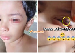 sengkenit melekat di mata anak bahaya