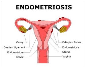 Endometriosis