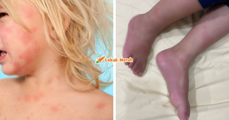 urticaria