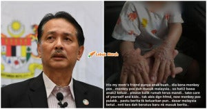 Ft Noor Hisham Respon Rumors Monkeypox