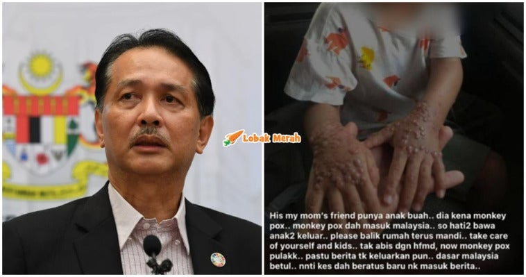 ft Noor Hisham Respon Rumors Monkeypox