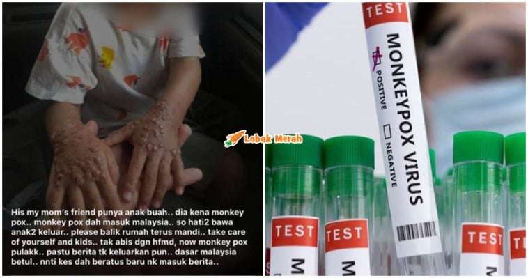 Nafi Ada Kes Monkeypox Di Msia