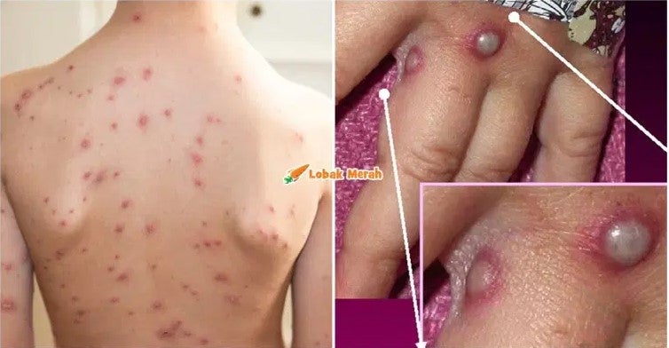 Pox