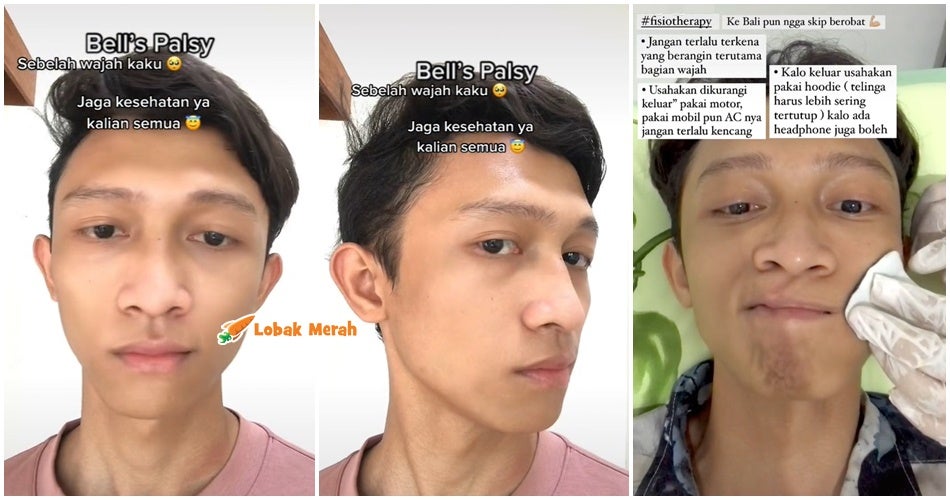 Lelaki Kena Bells Palsy