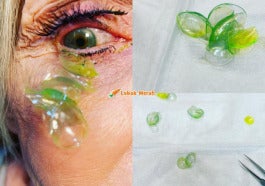 contact lens