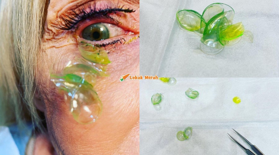 contact lens