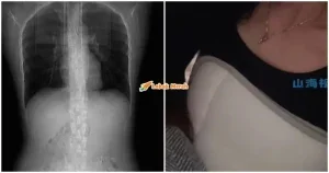 ft wanita patah tulangrusuk 758x399 1