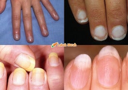 F1 Nail Health