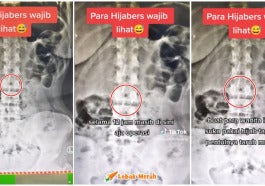 Ft Wanita Tertelan Jarum Peniti