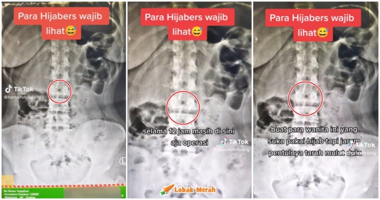 Ft Wanita Tertelan Jarum Peniti