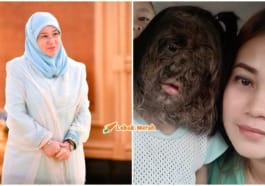 Raja Permaisuri Agong Ambil Anak Angkat Sindrom Werewolf