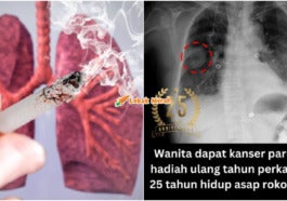 kanser paru-paru