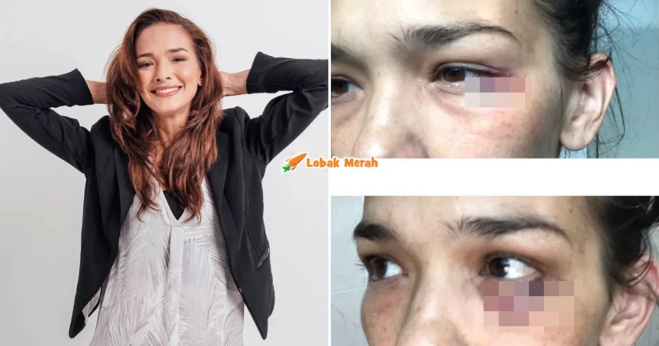 “Saya taknak buat ni…” – Muat Naik Gambar Mata Lebam, Netizen Risau Keadaan Zahnita?