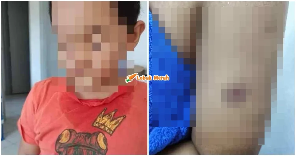 “Sampai terkel*ar kulit, kena air rasa pedih” – Murid Darjah 2 Trauma Ke Sekolah Dicubit Cikgu Sampai Berbekas