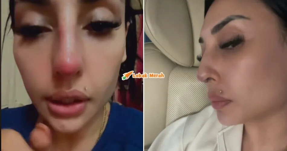 “I menyesal” – Terkena ‘Infection’, Zarina Anjoulie Menyesal ‘Buat Hidung’