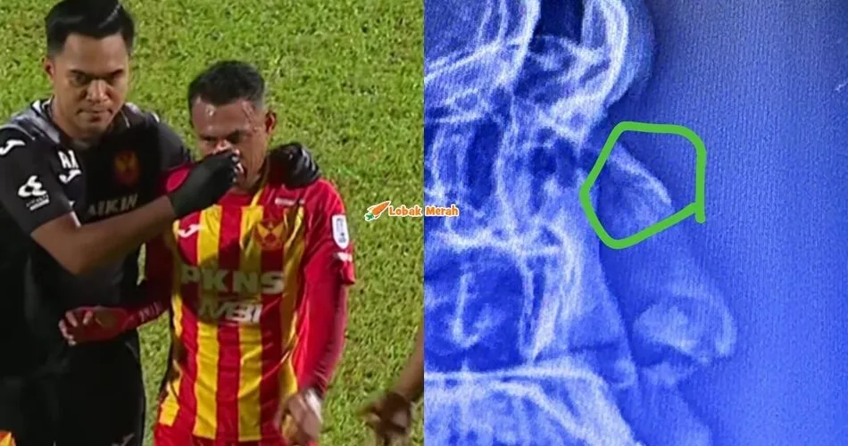 Faisal Halim Alami Kecederaan Patah Tulang Hidung, Kongsi Imej X-Ray