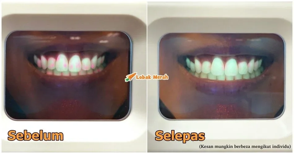 “Nampak bersih tapi penuh bakteria?” – Terkejut Bila Guna ‘Bacteria Detector’ Lepas Makan, Colgate Total Memang Penyelamat!