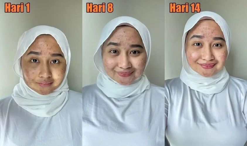Hanie Day 1 Frontal side