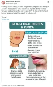 gejala oral herpes