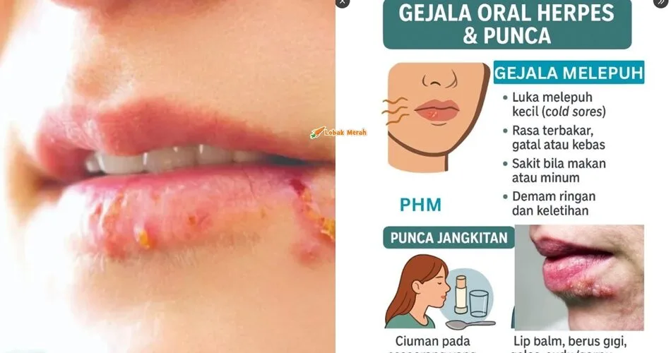 “Boleh dijangkiti jika guna gelas atau sudu yang tercemar dengan air liur seseorang yang dijangkiti”- Ini Gejala & Punca Oral Herpes