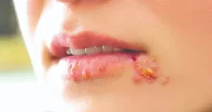 herpes mulut