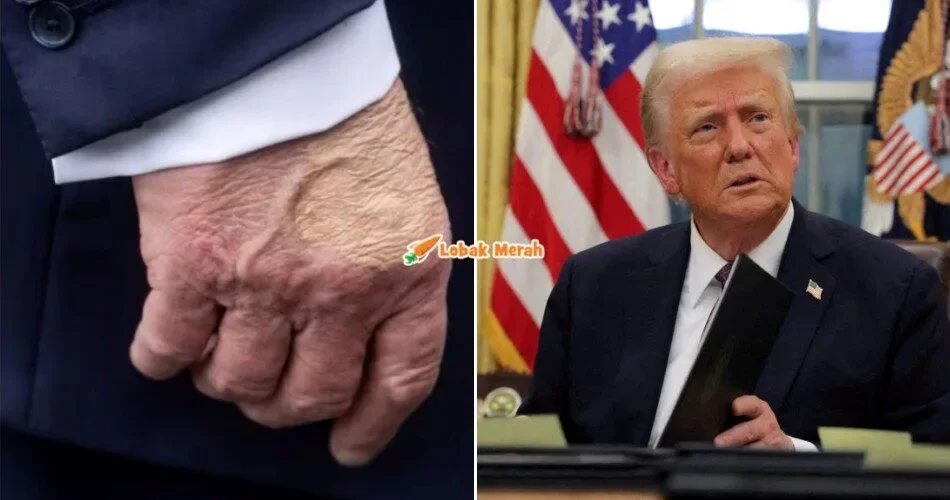 “Bengkak kaki, tangan lebam” – Donald Trump Hidap Penyakit Urat Kronik