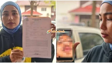 ft anak patah tulang hidung