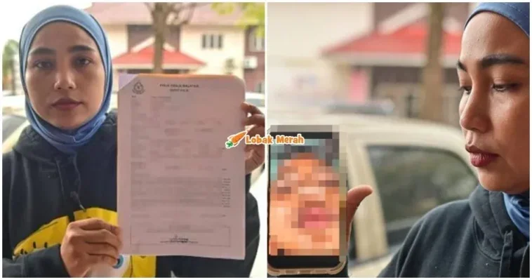 ft anak patah tulang hidung